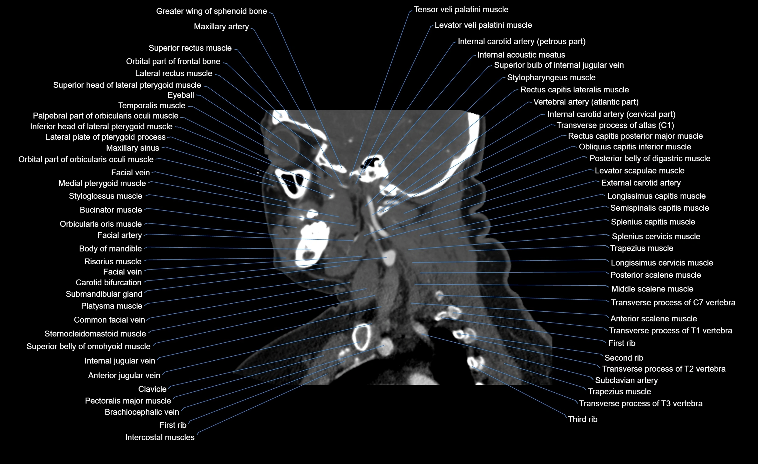 Neck CT sagittal cross sectional anatomy 3D  radiology  image-img-00001-00011.webp
